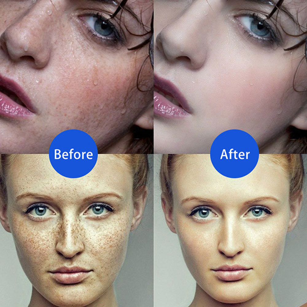 Electric Plasma Jet Pen Freckle Remover Machine  Mole Removal Dark