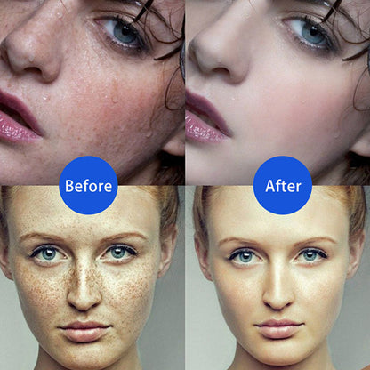 Electric Plasma Jet Pen Freckle Remover Machine  Mole Removal Dark